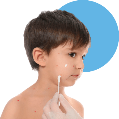 Criança sendo medicada contra a Varicela